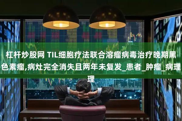杠杆炒股网 TIL细胞疗法联合溶瘤病毒治疗晚期黑色素瘤,病灶完全消失且两年未复发_患者_肿瘤_病理